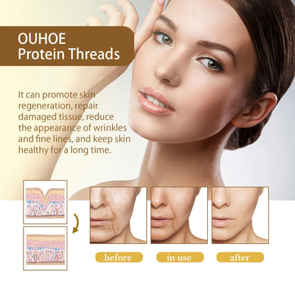 Soluble Protein Threads for Face Lifting Smoothes Fine Lines Improve Skin Elasticity & Firmness Absorbable Collagen Protein Line